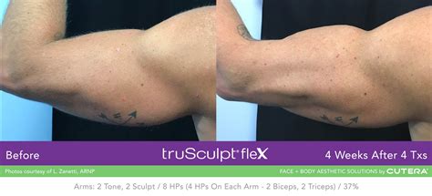truSculpt® Overview: Cost, Recovery, Before & After .